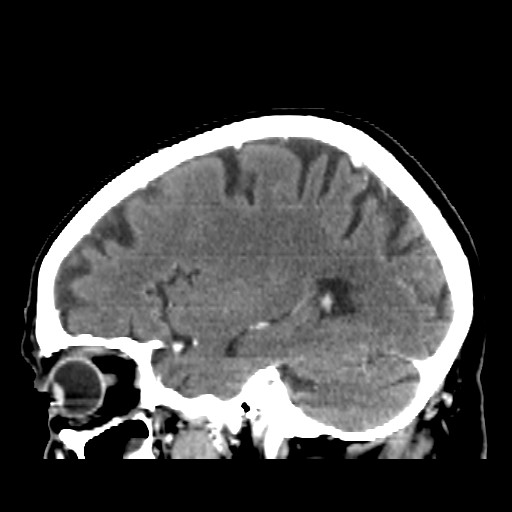 Brain metastasis (Radiopaedia 42617-45760 D 14).jpg
