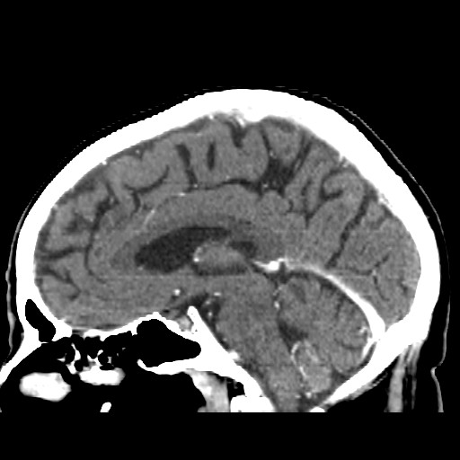 Brain metastasis (Radiopaedia 42617-45760 D 25).jpg
