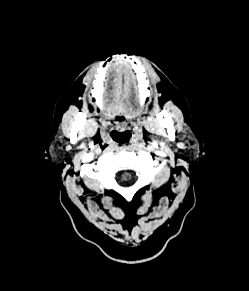 Brain metastasis (large cystic mass) (Radiopaedia 47497-52106 Axial C+ 6).png