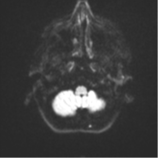 Brain metastasis (sarcoma) (Radiopaedia 47576-52209 Axial DWI 32).png