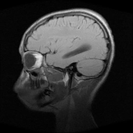 File:Brainstem glioma (Radiopaedia 30923-31624 Sagittal T1 14).jpg
