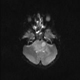 Brainstem glioma (Radiopaedia 67531-76922 Axial DWI 7).jpg