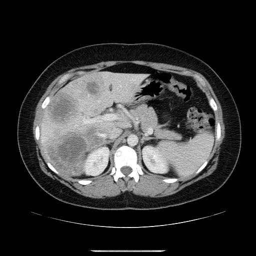 File:Breast cancer pseudocirrhosis after chemotherapy (Radiopaedia 65407-74456 Axial 5).jpg