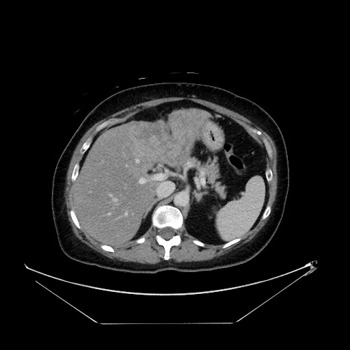 File:Breast cancer pseudocirrhosis with lobar invovlement (Radiopaedia 81080-94670 A 51).jpg