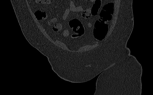 File:Breast carcinoma with pathological hip fracture (Radiopaedia 60314-67993 Coronal bone window 37).jpg