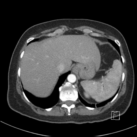 Breast metastases from renal cell cancer (Radiopaedia 79220-92225 A 80).jpg