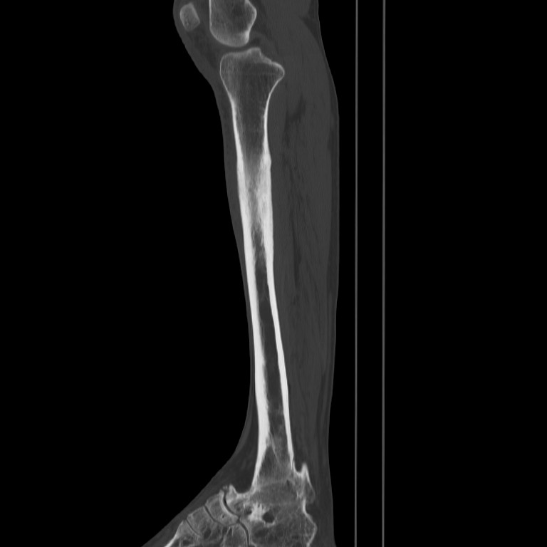 Brodie abscess - tibia (Radiopaedia 66028-75204 Sagittal bone window 29).jpg