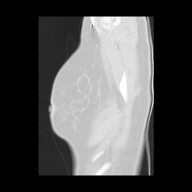 Bronchial atresia (Radiopaedia 22965-22992 Sagittal lung window 2).jpg