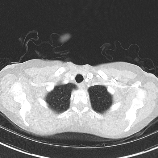 Bronchial atresia (Radiopaedia 73677-84470 Axial lung window 9).jpg