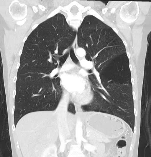 File:Bronchial atresia (Radiopaedia 73677-84470 Coronal lung window 18).jpg