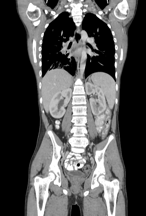Bronchial carcinoid tumor (Radiopaedia 57187-64090 B 72).jpg