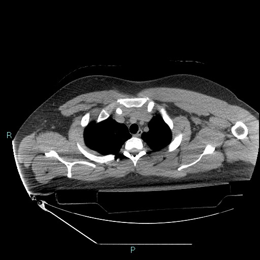 Bronchial carcinoid tumor (Radiopaedia 78272-90870 Axial non-contrast 18).jpg