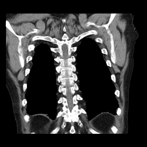 File:Bronchial stenosis - lung transplant (Radiopaedia 73133-83848 Coronal non-contrast 53).jpg