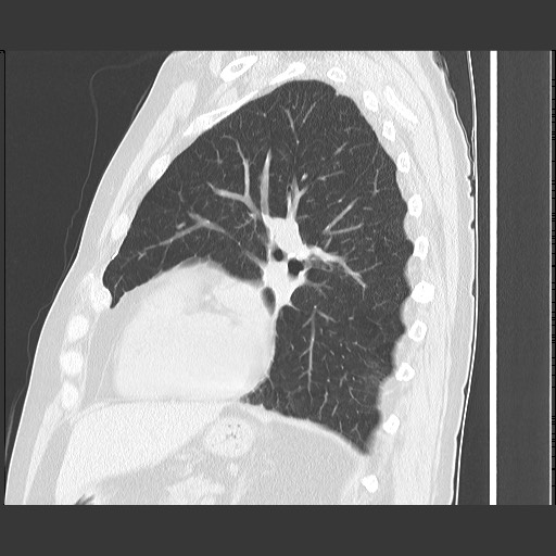 Bronchial stenosis - lung transplant (Radiopaedia 73133-83848 Sagittal lung window 45).jpg