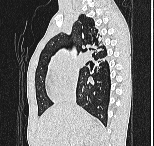 Bronchiolitis obliterans (Radiopaedia 71538-81897 Sagittal lung window 25).jpg
