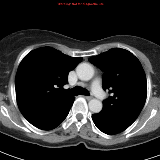 File:Bronchoalveolar carcinoma (BAC) (Radiopaedia 13436-13392 B 21).jpg