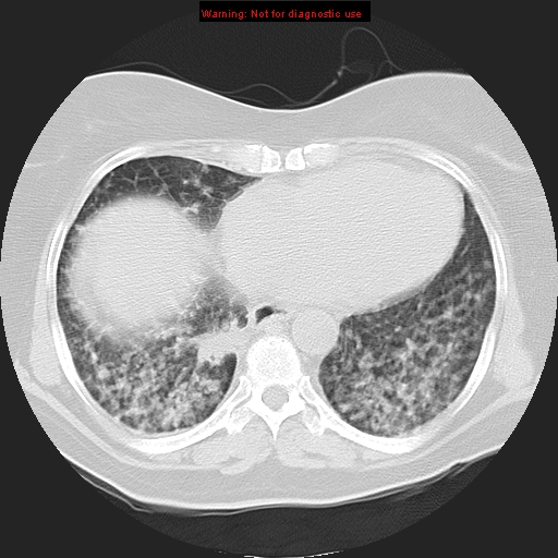 Bronchoalveolar carcinoma (Radiopaedia 13224-13233 Axial lung window 31).jpg