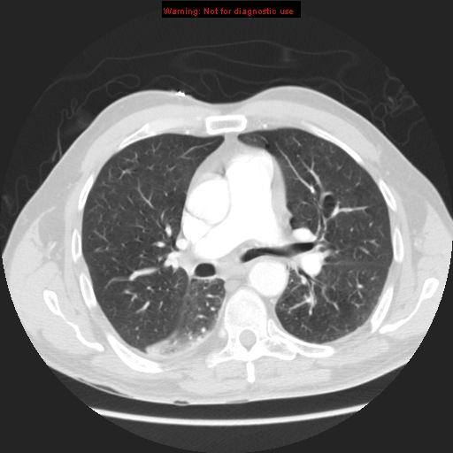 File:Bronchogenic carcinoma brain metastasis (Radiopaedia 9286-105832 Axial lung window 4).jpg