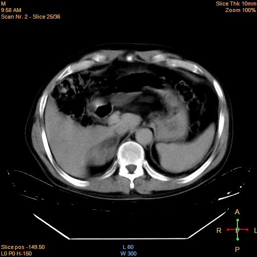 File:Bronchogenic carcinoma with superior vena caval invasion (Radiopaedia 22378-22406 Mediastinal window 22).jpg
