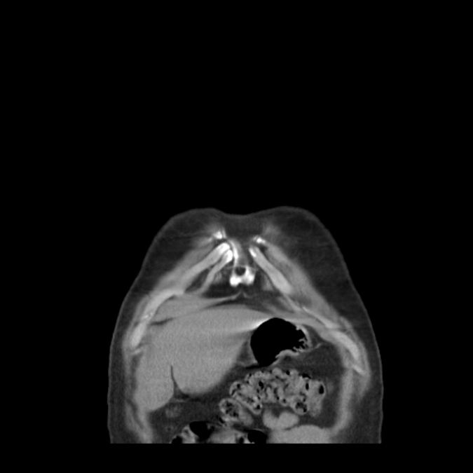 Bronchogenic carcinoma with upper lobe collapse (Radiopaedia 29297-29726 D 6).jpg