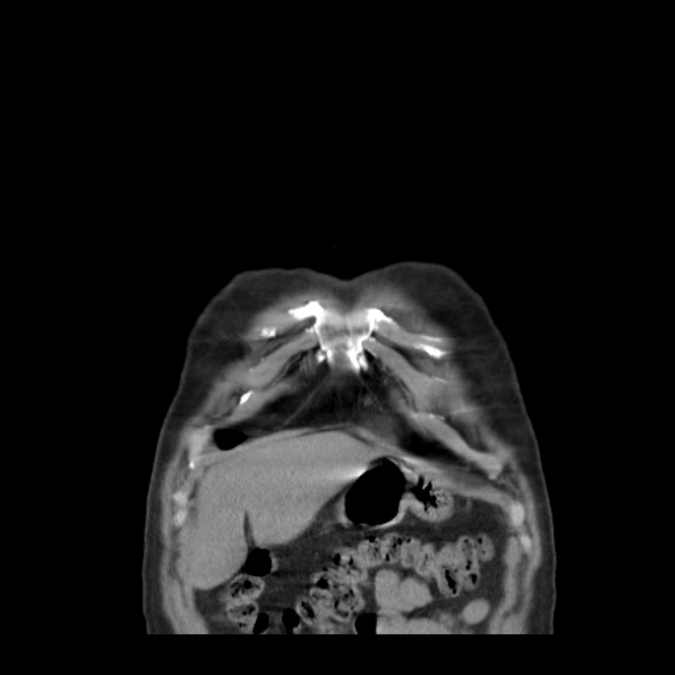 Bronchogenic carcinoma with upper lobe collapse (Radiopaedia 29297-29726 D 8).jpg