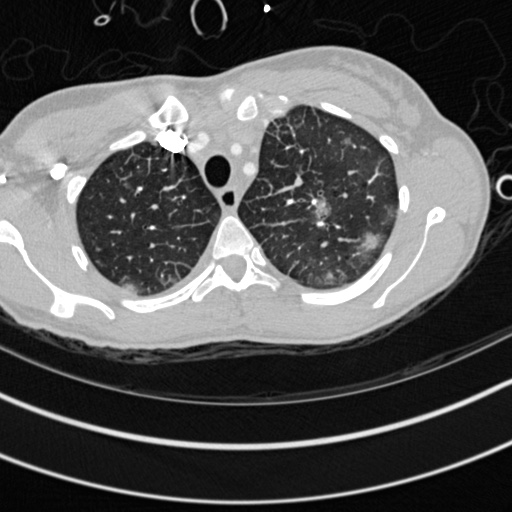 Bronchogenic cyst (Radiopaedia 77801-90071 Axial lung window 6).jpg