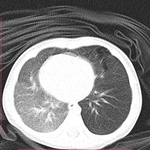 Bronchogenic cyst (Radiopaedia 78599-91409 Axial lung window 93).jpg