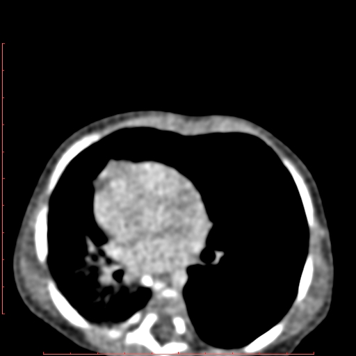 Bronchogenic cyst (Radiopaedia 78599-91409 B 113).jpg