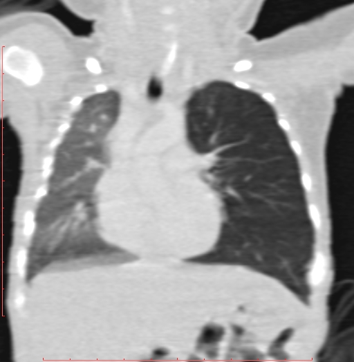 Bronchogenic cyst (Radiopaedia 78599-91409 Coronal lung window 106).jpg