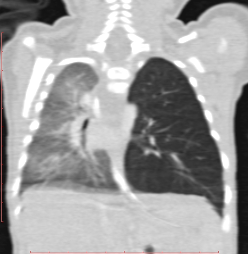 Bronchogenic cyst (Radiopaedia 78599-91409 Coronal lung window 145).jpg