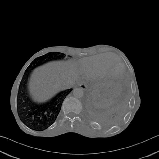 File:Bronchopleural fistula secondary to tuberculosis (Radiopaedia 20415-20322 Axial bone window 24).jpg