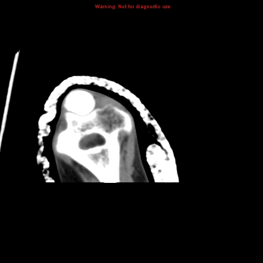 Brown tumor (Radiopaedia 12460-12694 Axial non-contrast 139).jpg