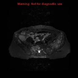 File:Brown tumors (Radiopaedia 9666-10290 Axial T2 fat sat 6).jpg