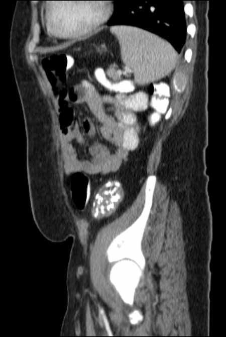 Brown tumors compressing the spinal cord (Radiopaedia 68442-77988 F 43).jpg