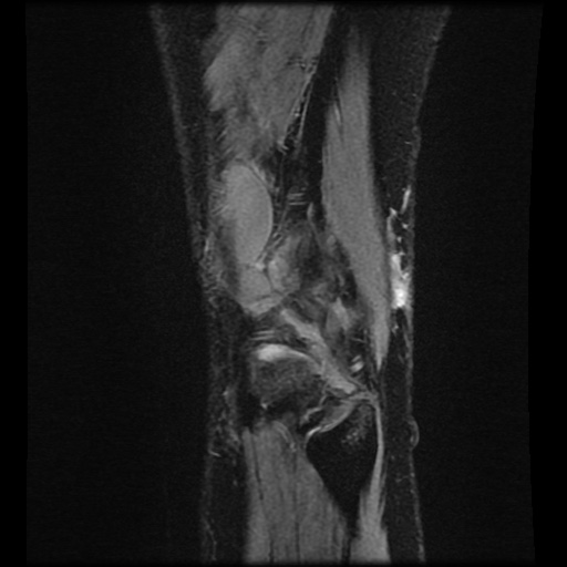 Bucket handle meniscus tear (Radiopaedia 56916-63751 H 4).jpg