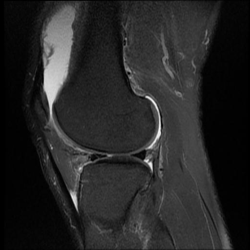File:Bucket handle tear - medial meniscus (Radiopaedia 69245-79026 Sagittal PD fat sat 5).jpg