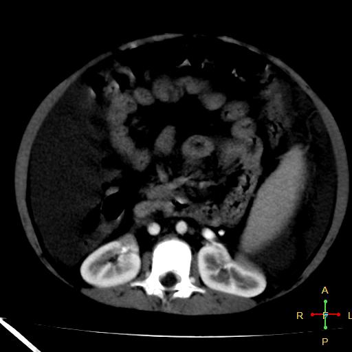 File:Budd-Chiari syndrome (Radiopaedia 23072-23103 C+ arterial phase 15).jpg