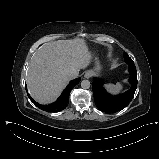 File:Buried bumper syndrome - gastrostomy tube (Radiopaedia 63843-72577 Axial Inject 16).jpg