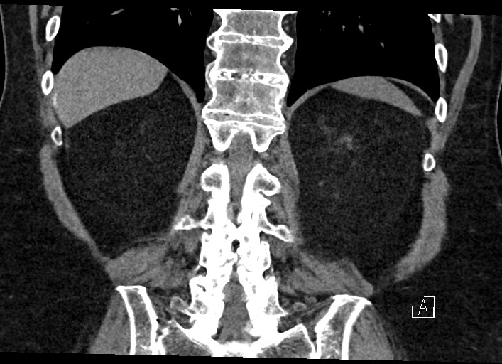 File:Buried bumper syndrome - gastrostomy tube (Radiopaedia 63843-72577 Coronal Inject 106).jpg