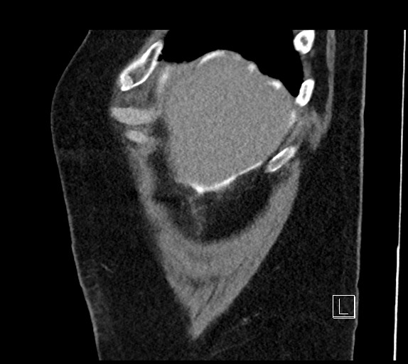Buried bumper syndrome - gastrostomy tube (Radiopaedia 63843-72577 Sagittal Inject 109).jpg