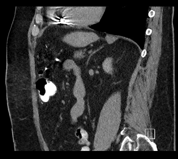 Buried bumper syndrome - gastrostomy tube (Radiopaedia 63843-72577 Sagittal Inject 42).jpg