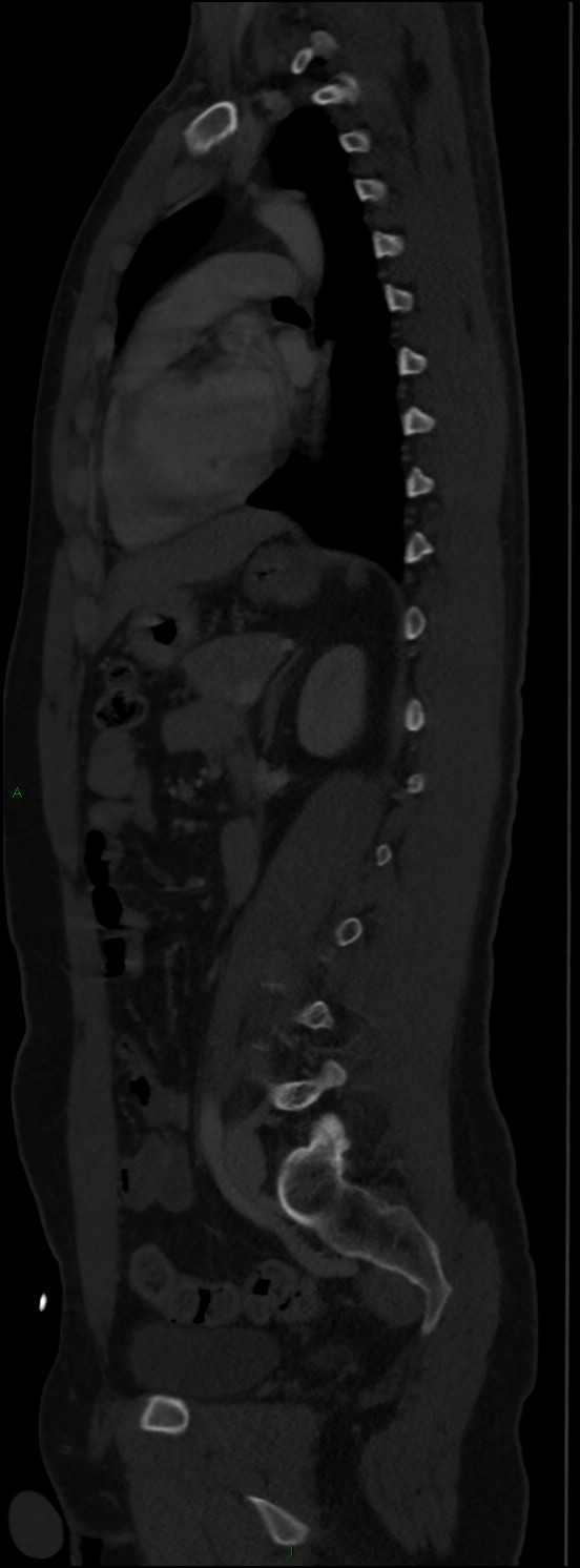 Burst fracture (Radiopaedia 83168-97542 Sagittal bone window 78).jpg