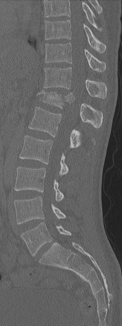 Burst fracture - T12 with conus compression (Radiopaedia 56825-63647 Sagittal bone window 40).png