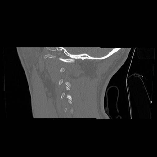 File:C1-C2 "subluxation" - normal cervical anatomy at maximum head rotation (Radiopaedia 42483-45607 C 5).jpg