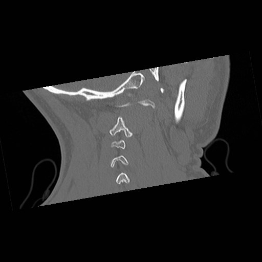 C1-C2 "subluxation" - normal cervical anatomy at maximum head rotation (Radiopaedia 42483-45607 Coronal non-contrast 50).jpg