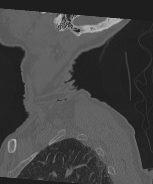 C2 fracture with vertebral artery dissection (Radiopaedia 37378-39199 Sagittal bone window 8).png