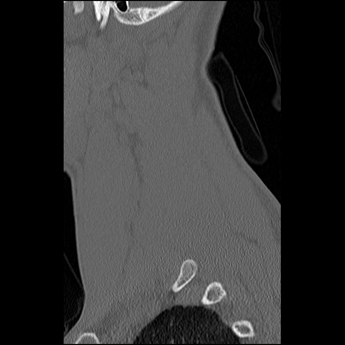 C5 facet fracture (Radiopaedia 58374-65499 Sagittal bone window 16).jpg