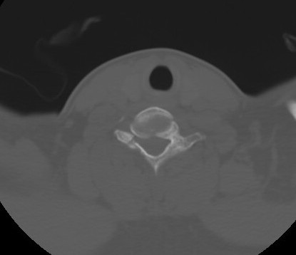 C7 laminar fracture and Klippel-Feil syndrome (Radiopaedia 86710-102850 Axial bone window 56).jpg