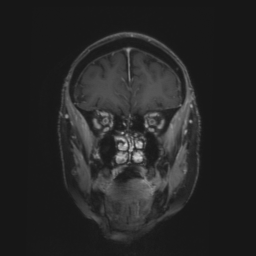 CNS lymphoma with steroid response (Radiopaedia 37980-39921 Coronal T1 C+ 7).png