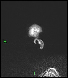 CNS manifestations of NF1 - optic pathway glioma, neurofibroma, dural ectasia (Radiopaedia 37874-39805 Sagittal FLAIR 2).jpg